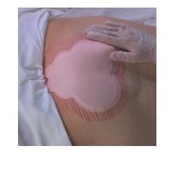 MEDICAZIONE IDROCELLULARE ADESIVA STERILE CONFORMATA PER LA REGIONE SACRALE ASSORBENTE IN SCHIUMA DI POLIURETANO ALLEVYN SACRUM 22,5X22,1CM 10PZ - farmavitality.it